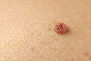 Photo of Man with mole on his skin, closeup