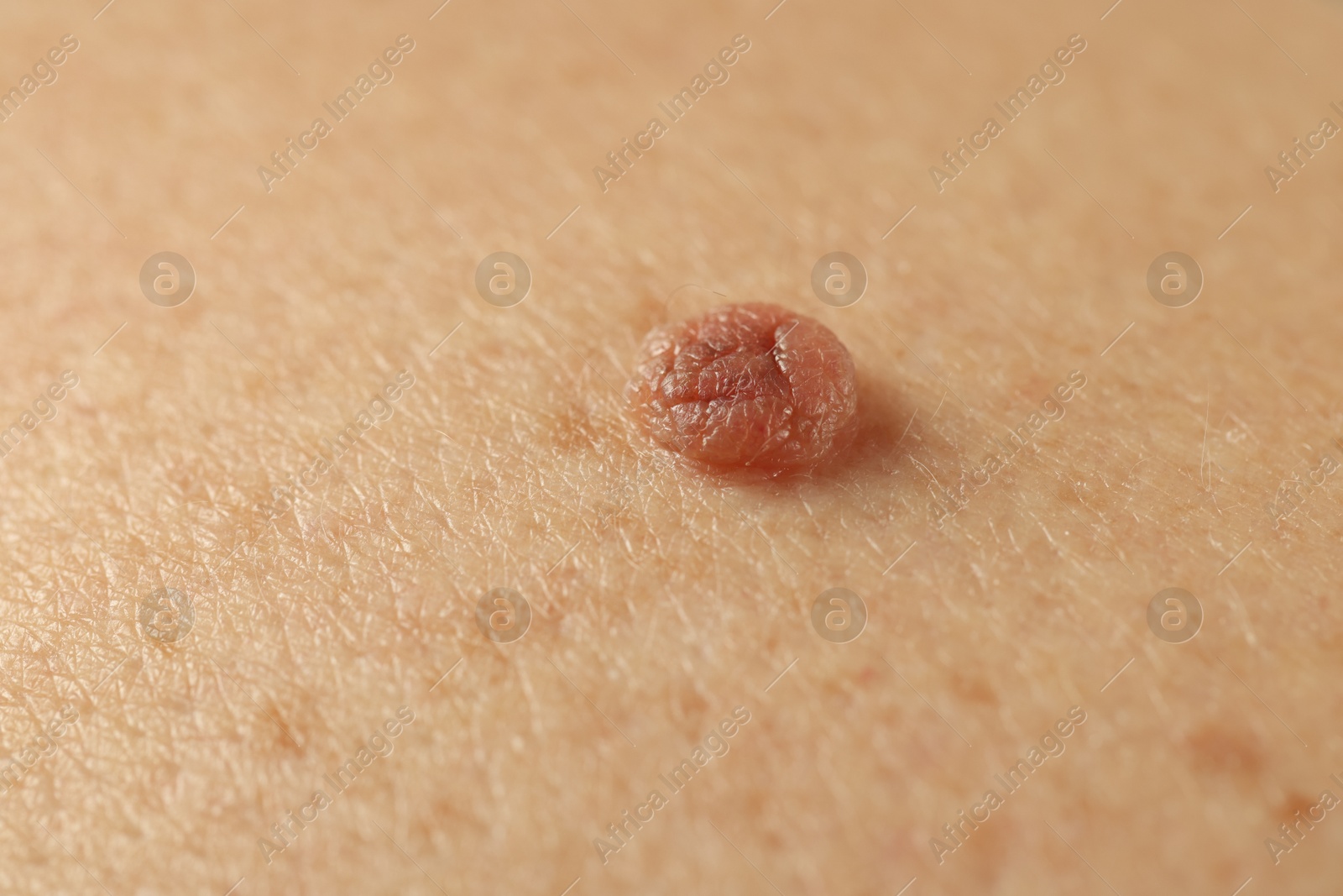 Man with mole on his skin, closeup Photo of Man with mole on his skin, closeup