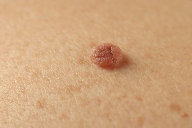 Photo of Man with mole on his skin, closeup