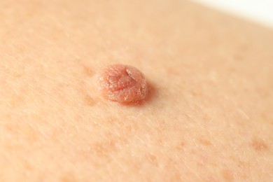 Photo of Man with mole on his skin, closeup