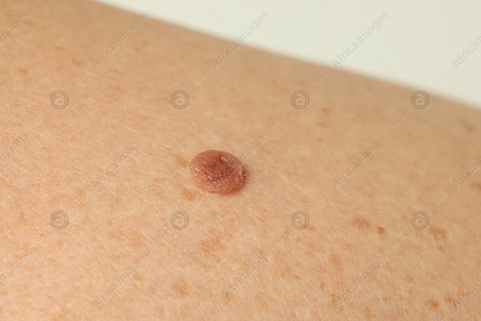 Man with mole on his skin against light background, closeup Photo of Man with mole on his skin against light background, closeup
