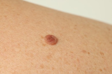 Photo of Man with mole on his skin against light background, closeup