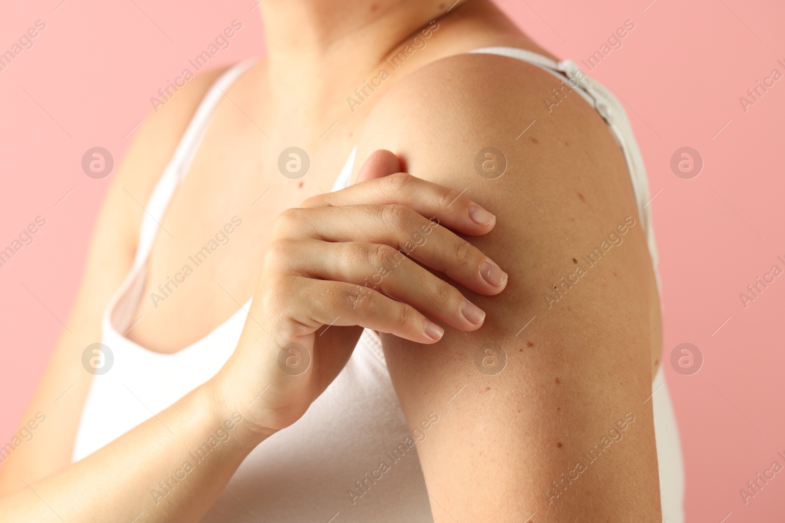 Woman with moles on her skin against pink background, closeup Photo of Woman with moles on her skin against pink background, closeup