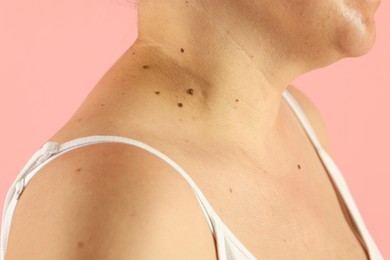 Photo of Woman with moles on her skin against pink background, closeup