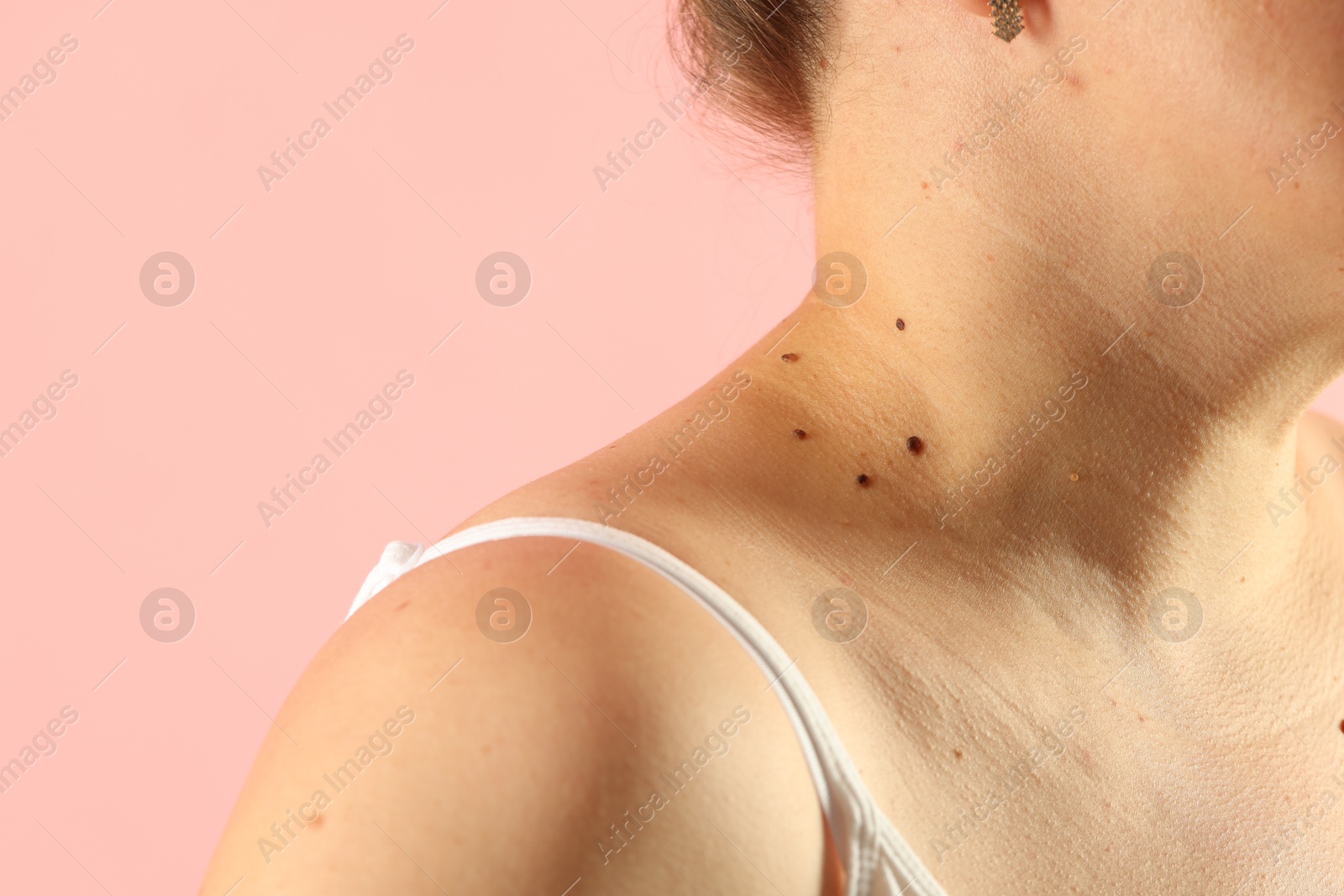 Woman with moles on her skin against pink background, closeup Photo of Woman with moles on her skin against pink background, closeup