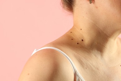 Photo of Woman with moles on her skin against pink background, closeup