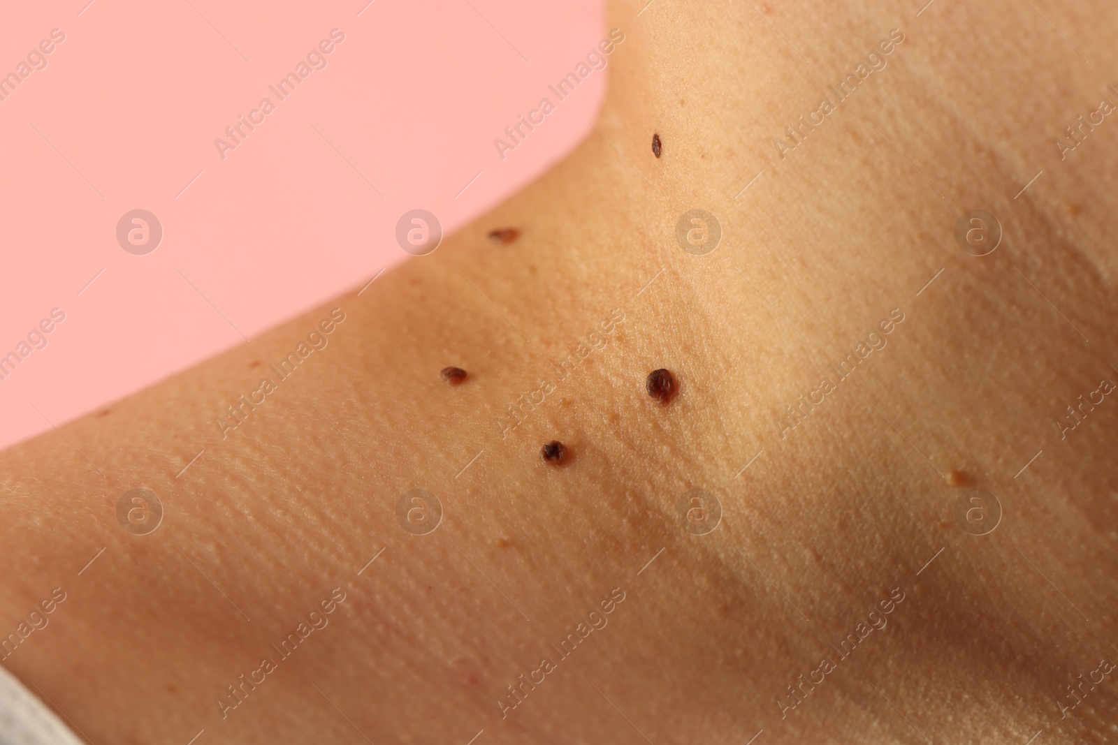Woman with moles on her skin against pink background, closeup Photo of Woman with moles on her skin against pink background, closeup