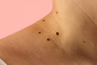 Photo of Woman with moles on her skin against pink background, closeup