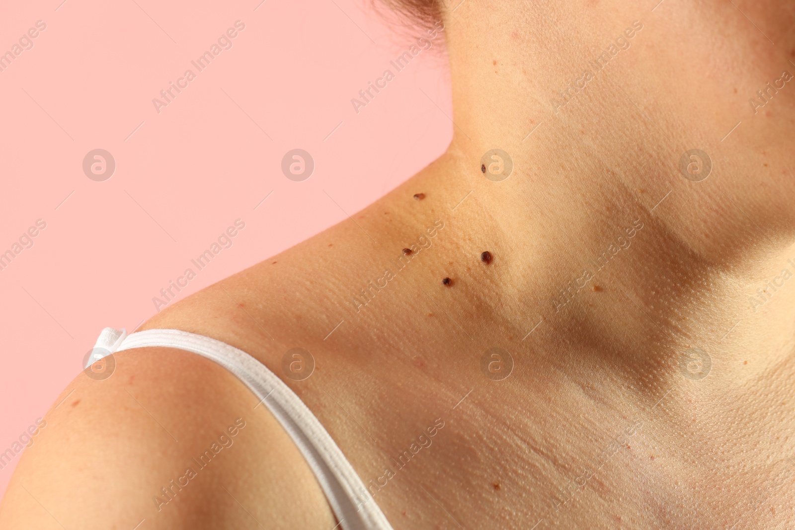 Woman with moles on her skin against pink background, closeup Photo of Woman with moles on her skin against pink background, closeup