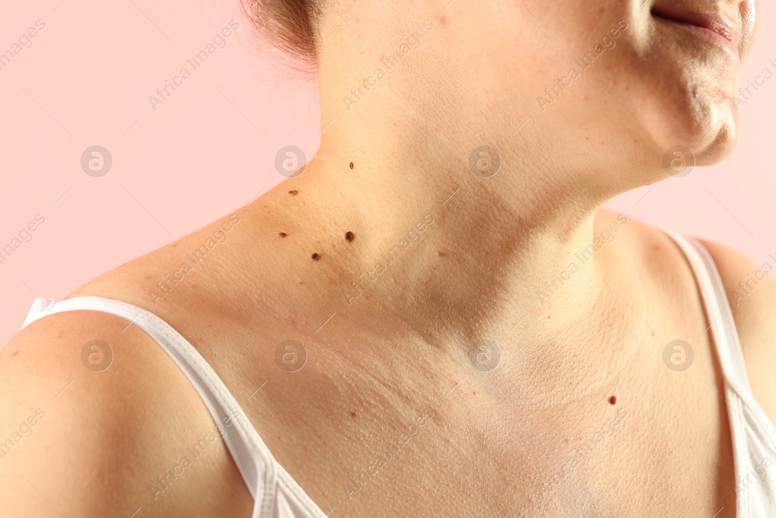 Woman with moles on her skin against pink background, closeup Photo of Woman with moles on her skin against pink background, closeup