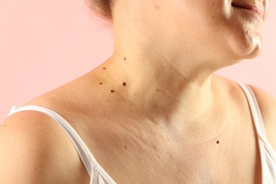 Photo of Woman with moles on her skin against pink background, closeup