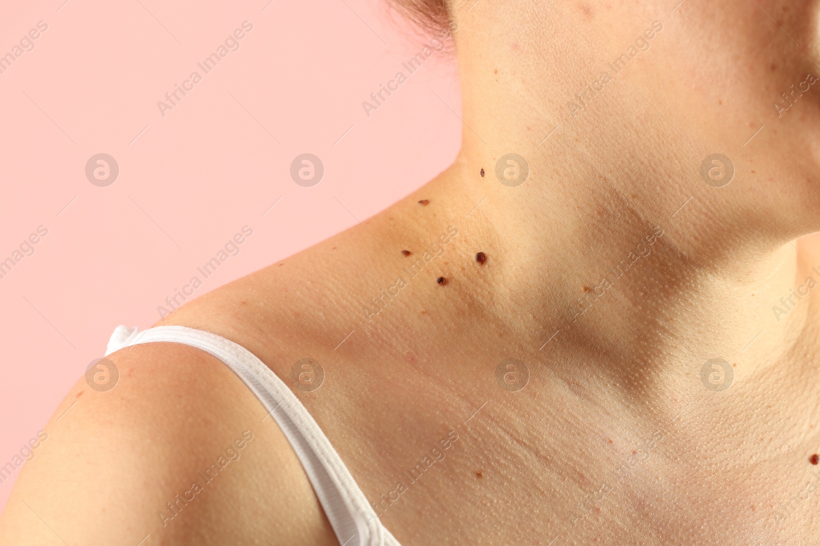 Woman with moles on her skin against pink background, closeup Photo of Woman with moles on her skin against pink background, closeup