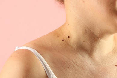 Photo of Woman with moles on her skin against pink background, closeup