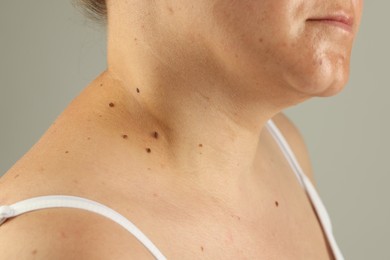 Photo of Woman with moles on her skin against grey background, closeup