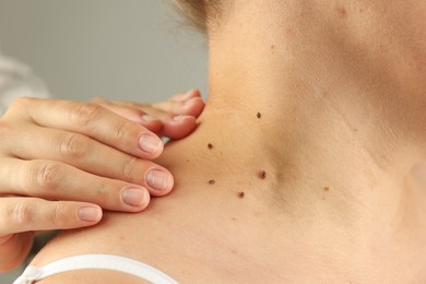 Photo of Doctor examining woman's moles on light grey background, closeup