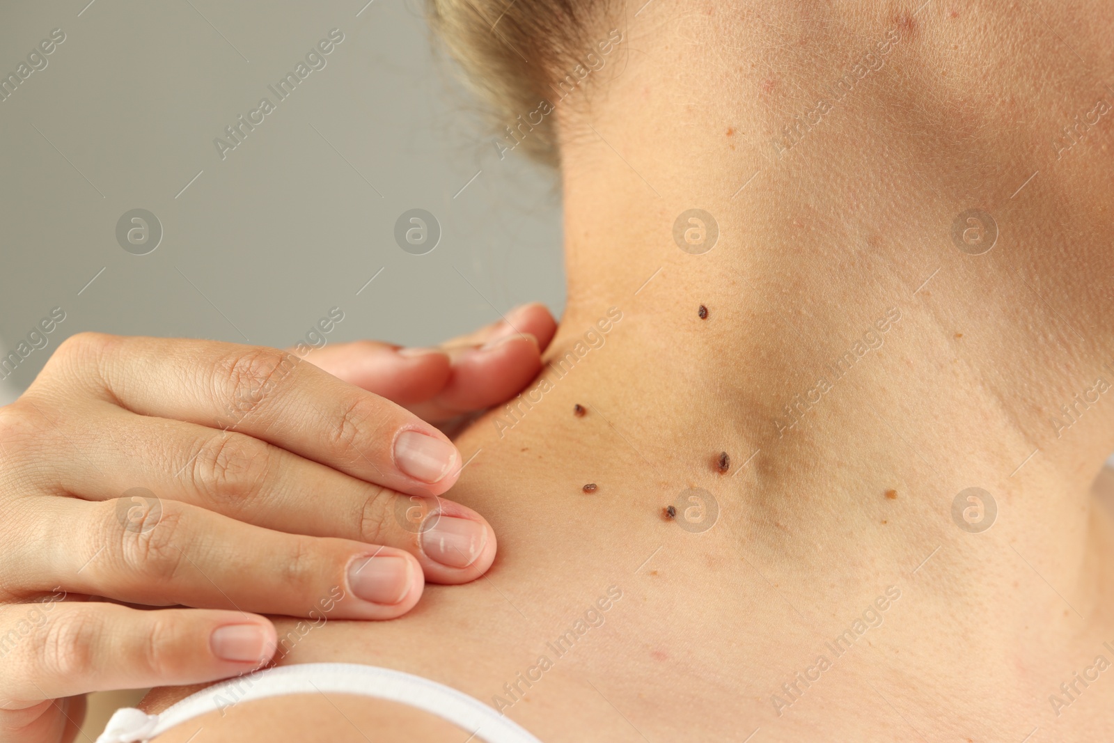 Doctor examining woman's moles on light grey background, closeup Photo of Doctor examining woman's moles on light grey background, closeup