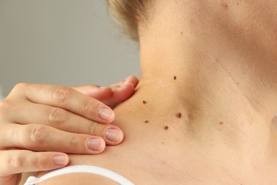 Photo of Doctor examining woman's moles on light grey background, closeup