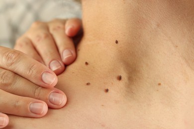 Photo of Doctor examining woman's moles on blurred background, closeup