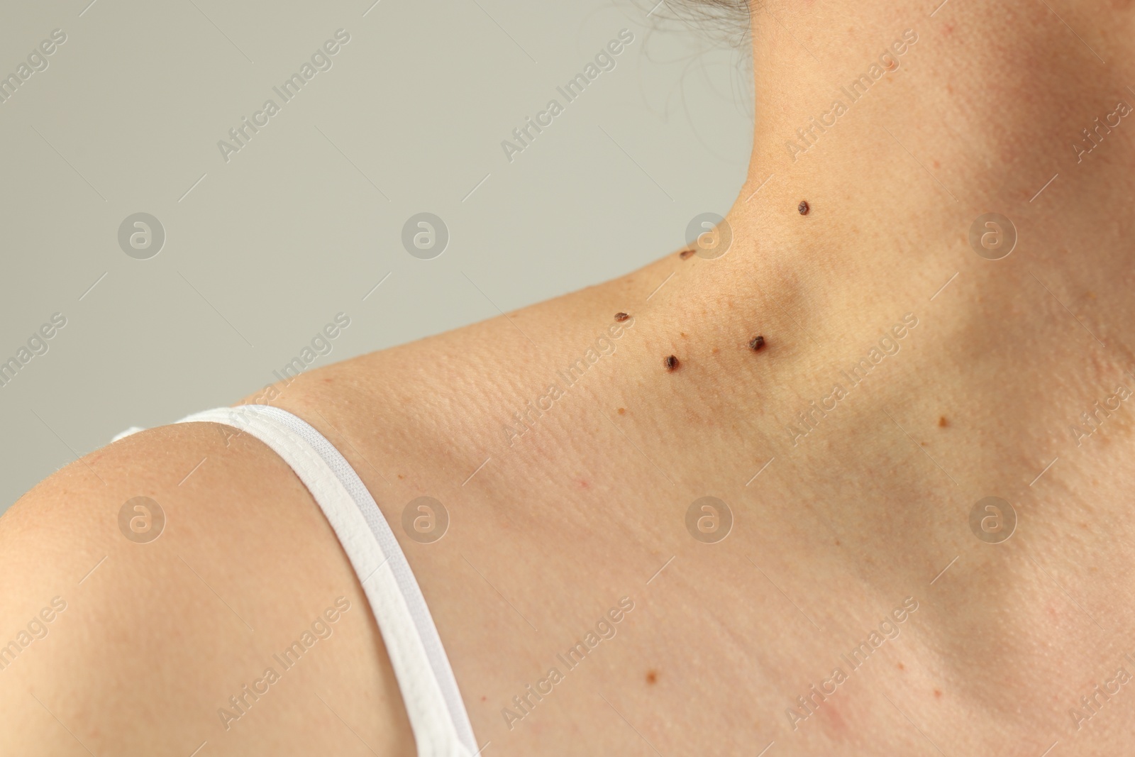 Woman with moles on her skin against grey background, closeup Photo of Woman with moles on her skin against grey background, closeup