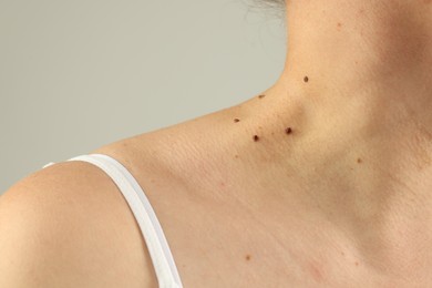 Photo of Woman with moles on her skin against grey background, closeup