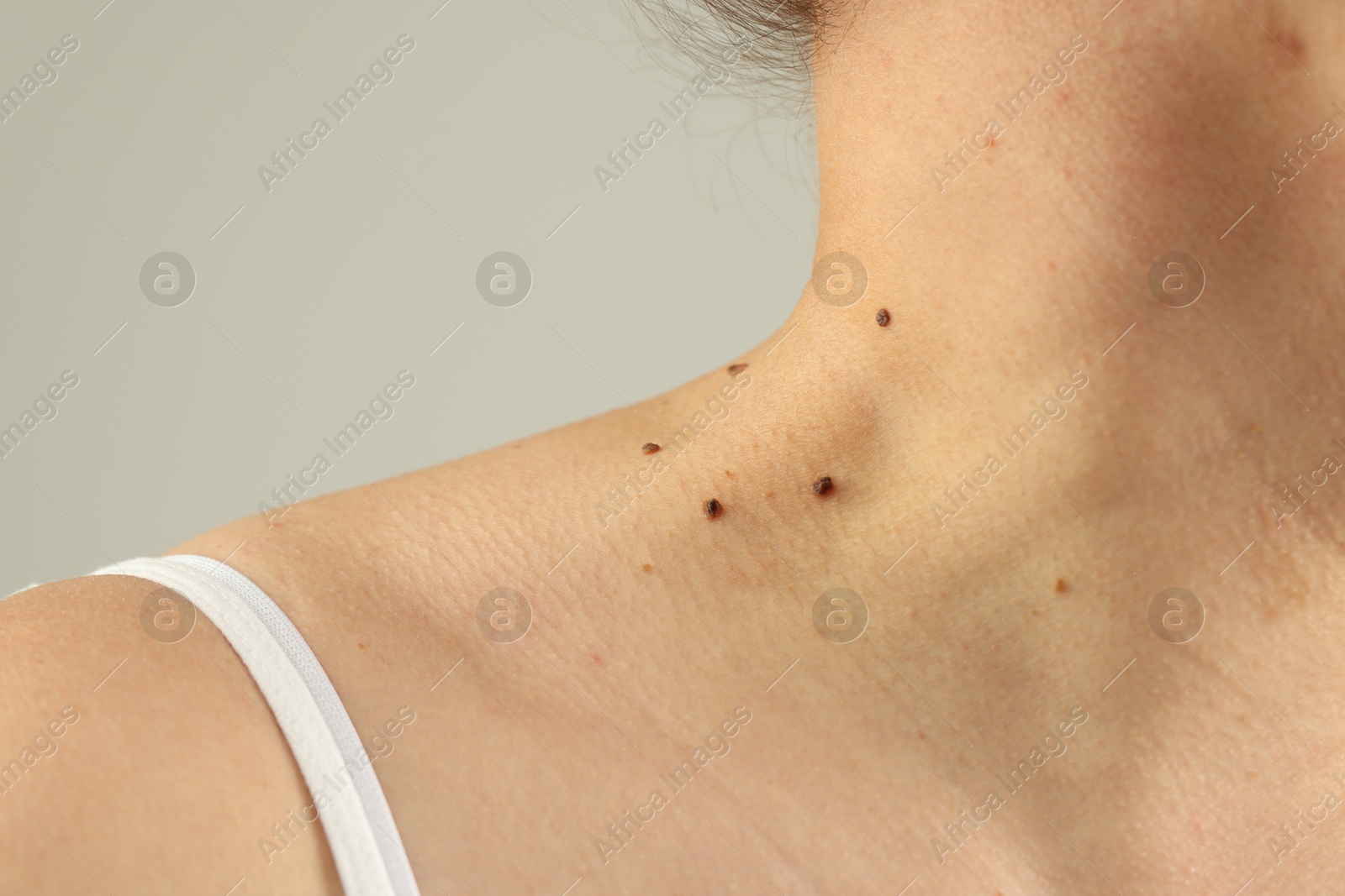 Woman with moles on her skin against grey background, closeup Photo of Woman with moles on her skin against grey background, closeup