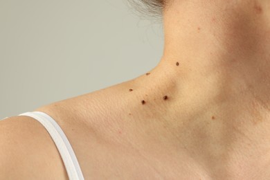 Photo of Woman with moles on her skin against grey background, closeup