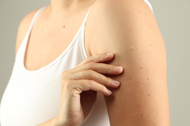 Photo of Woman with moles on her skin against grey background, closeup