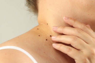 Photo of Woman with moles on her skin against grey background, closeup