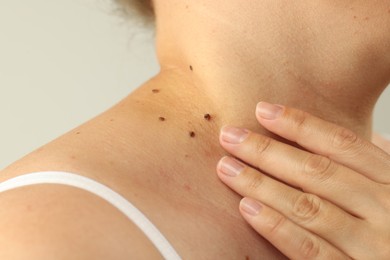 Photo of Woman with moles on her skin against grey background, closeup
