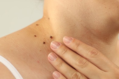 Photo of Woman with moles on her skin against grey background, closeup