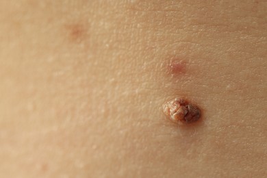 Photo of Woman with mole on her skin, closeup