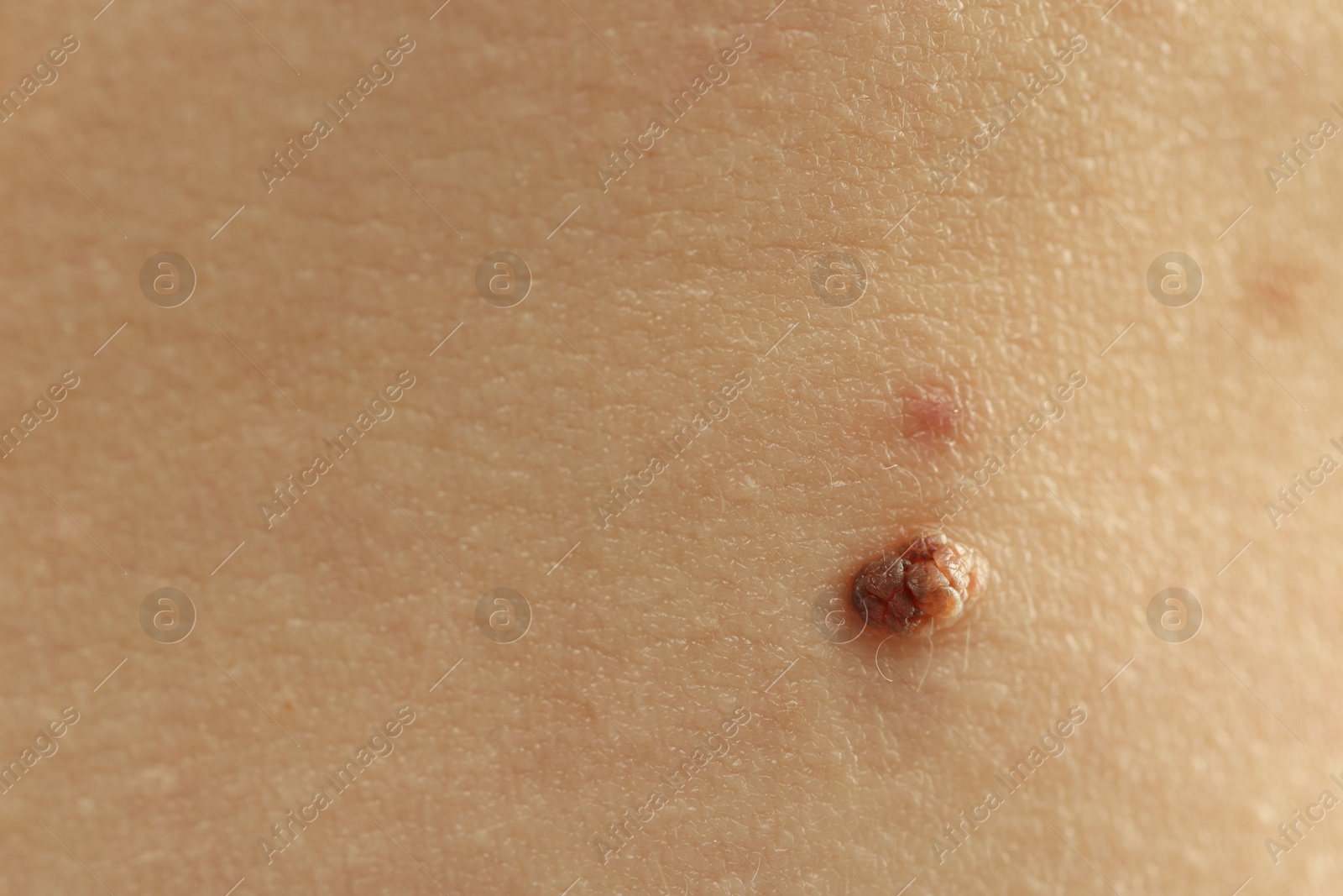 Woman with mole on her skin, closeup Photo of Woman with mole on her skin, closeup