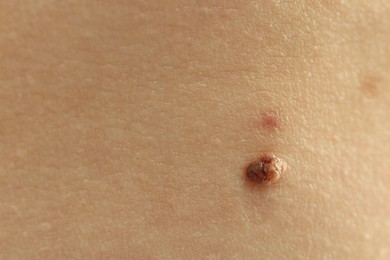 Photo of Woman with mole on her skin, closeup