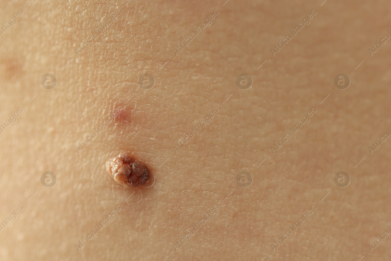 Woman with mole on her skin, closeup Photo of Woman with mole on her skin, closeup
