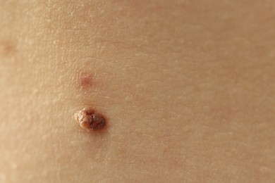 Photo of Woman with mole on her skin, closeup