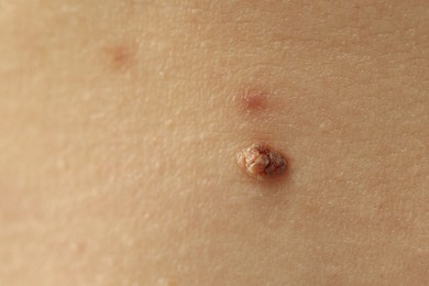 Photo of Woman with mole on her skin, closeup