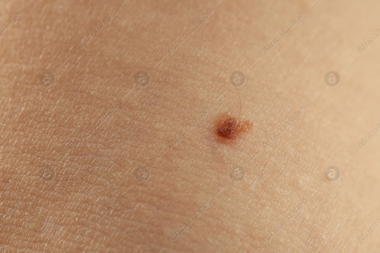 Woman with mole on her skin, closeup Photo of Woman with mole on her skin, closeup