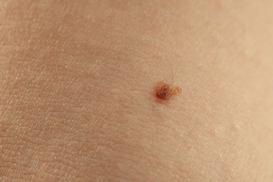 Photo of Woman with mole on her skin, closeup