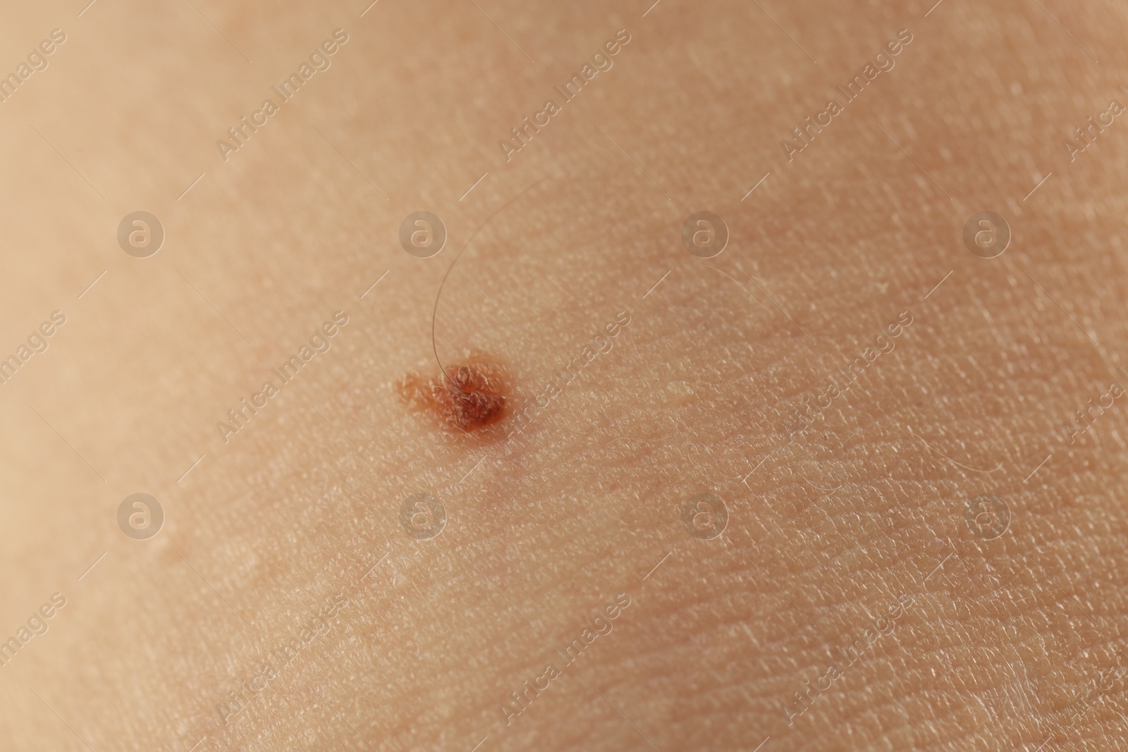 Woman with mole on her skin, closeup Photo of Woman with mole on her skin, closeup