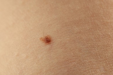 Photo of Woman with mole on her skin, closeup