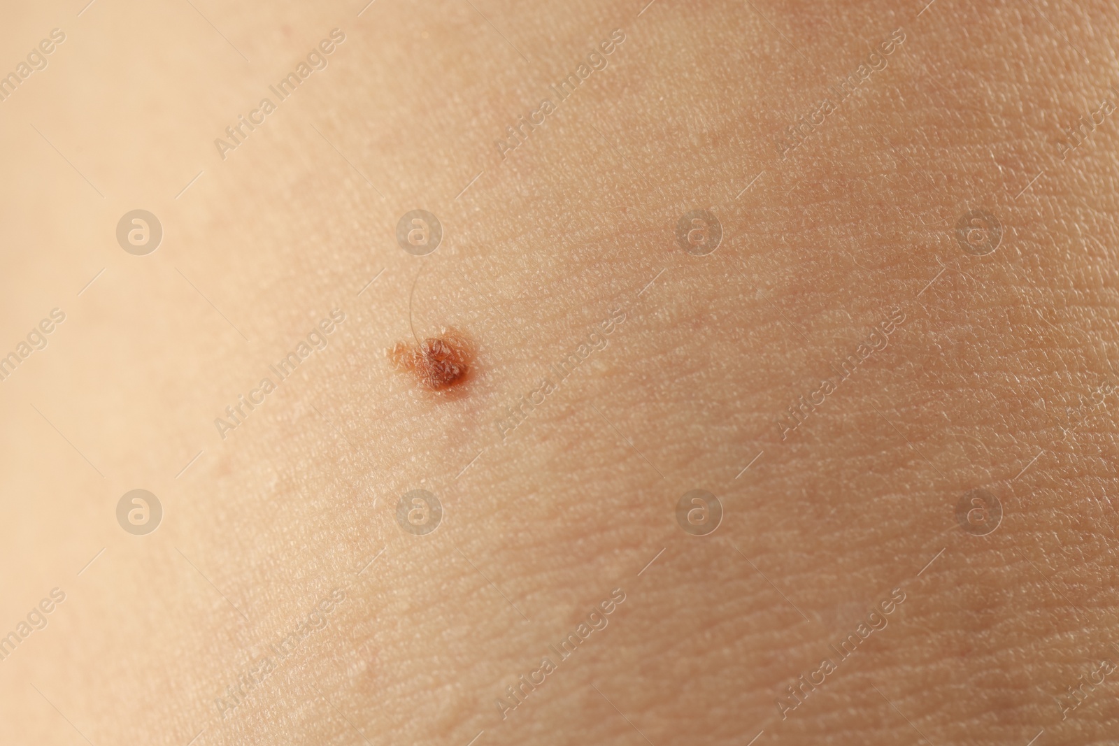 Woman with mole on her skin, closeup Photo of Woman with mole on her skin, closeup
