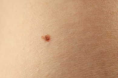 Photo of Woman with mole on her skin, closeup