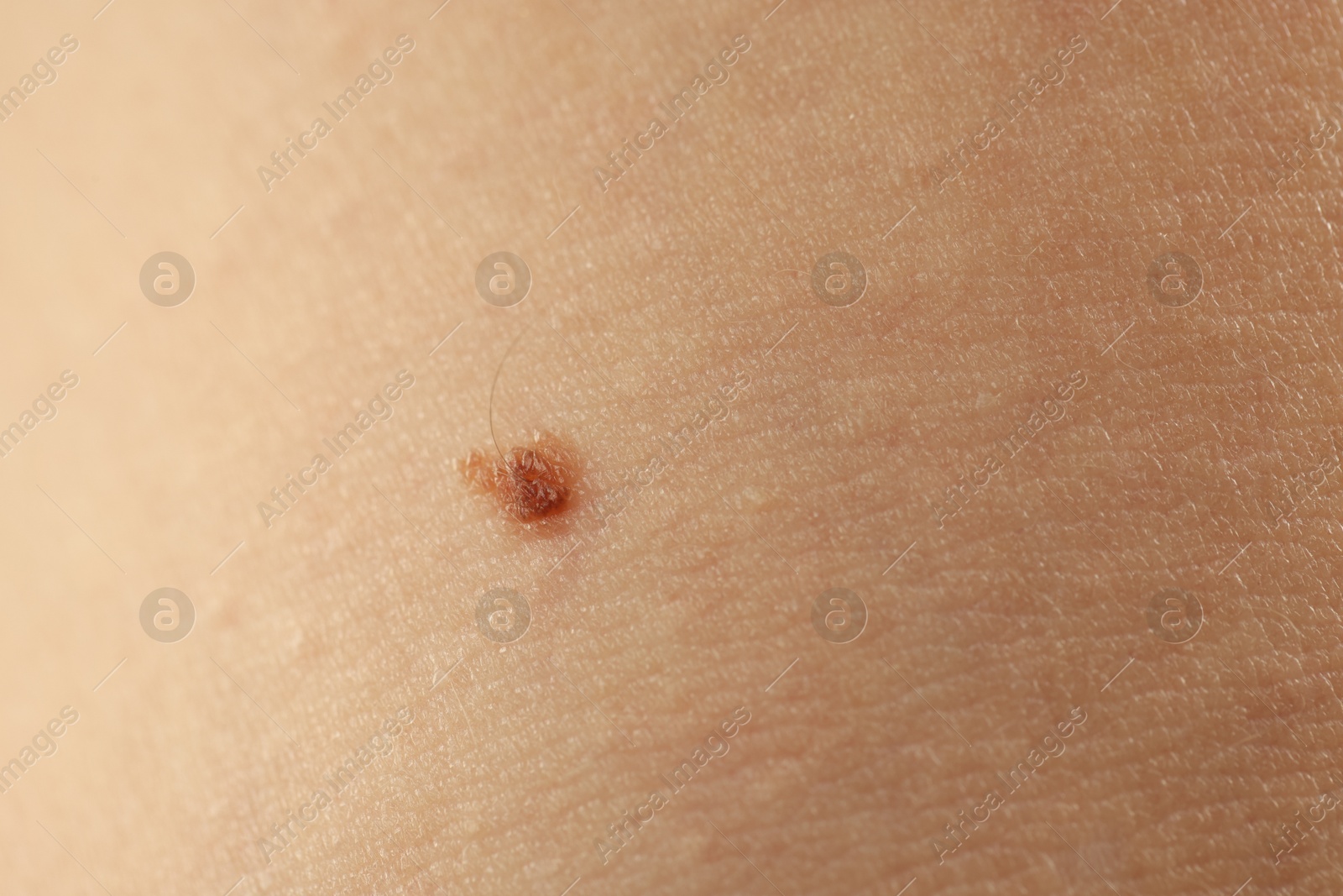 Woman with mole on her skin, closeup Photo of Woman with mole on her skin, closeup