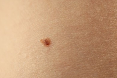 Photo of Woman with mole on her skin, closeup