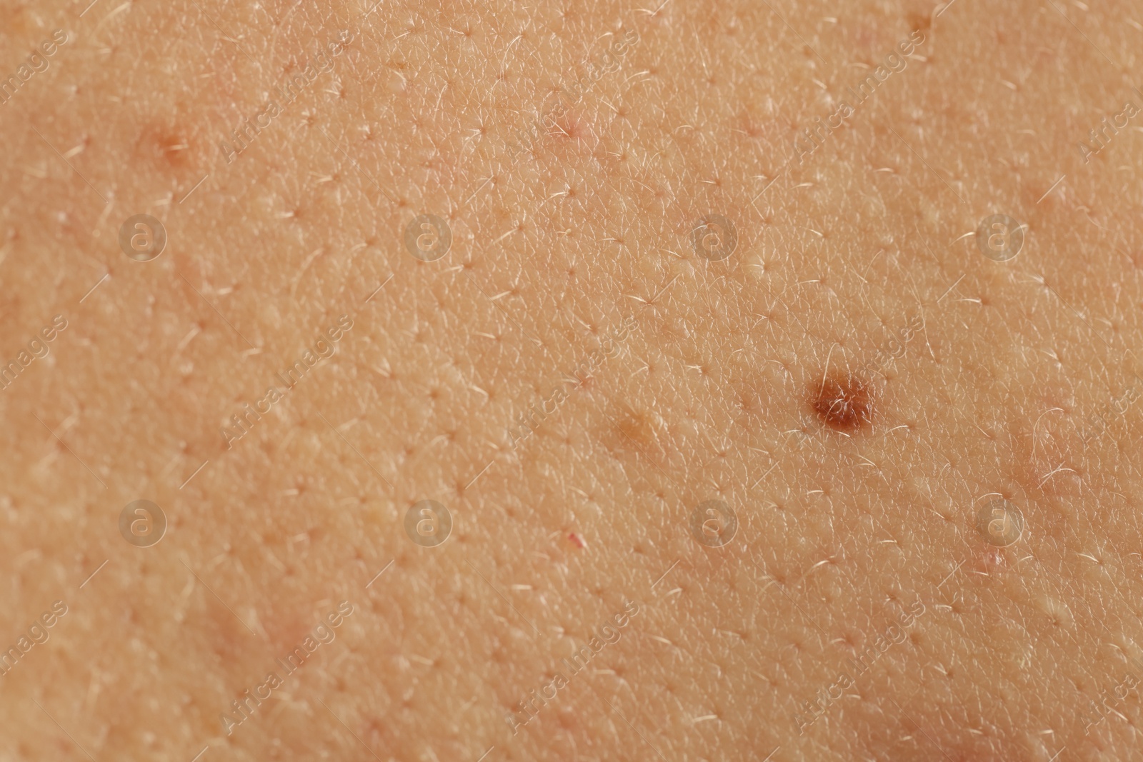 Woman with mole on her skin, closeup Photo of Woman with mole on her skin, closeup