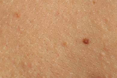 Photo of Woman with mole on her skin, closeup
