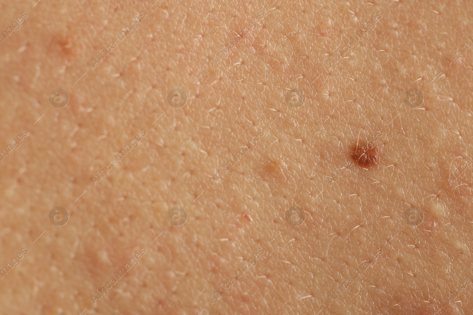 Woman with mole on her skin, closeup Photo of Woman with mole on her skin, closeup