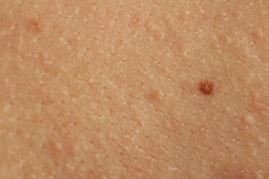 Photo of Woman with mole on her skin, closeup