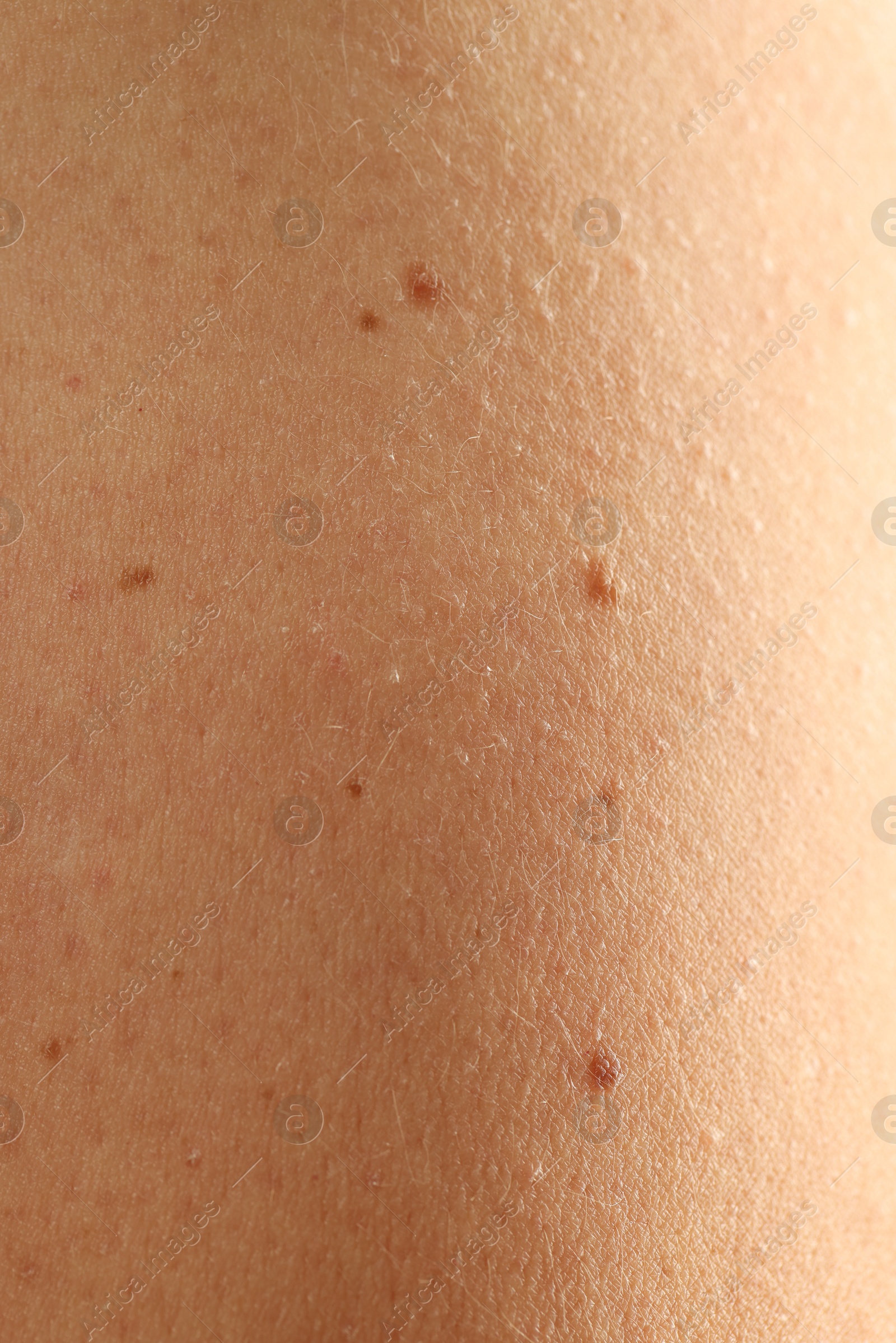 Woman with moles on her skin, closeup Photo of Woman with moles on her skin, closeup