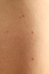 Photo of Woman with moles on her skin, closeup